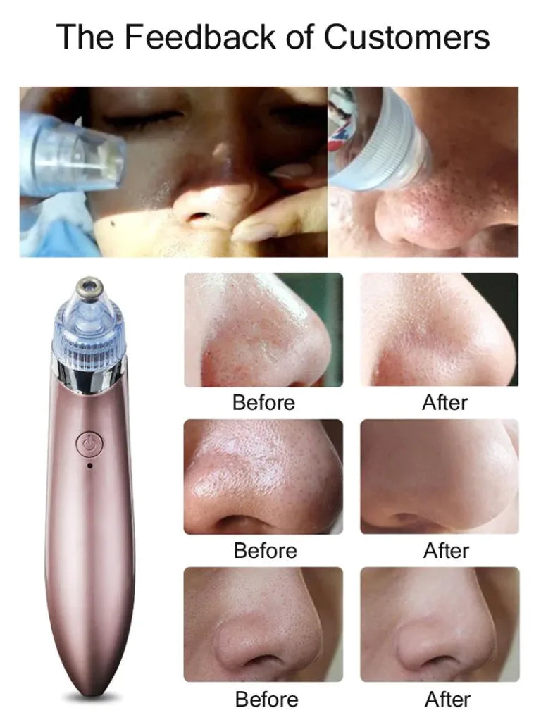 5 in 1 Electric Blackhead Acne Oil Remover